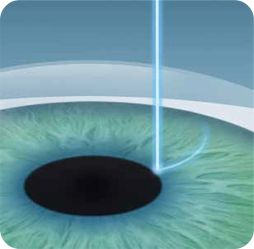 LaserVision, Οφθαλμίατρος, Κανελλόπουλος, μέθοδος επέμβασης Smile® PRO