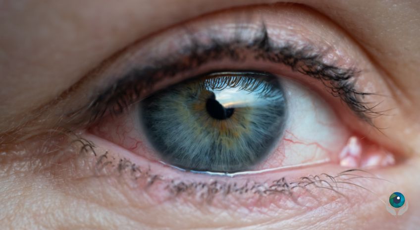 glaucoma